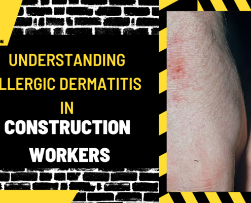 Understanding Allergic Dermatitis in Construction Workers